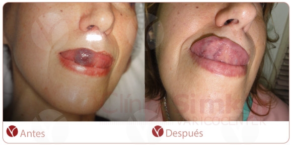 Angioma de labios, boca y lengua. Angioma de labios, boca y lengua.