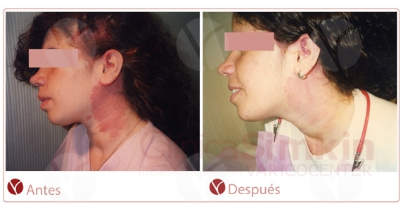 antes-y-despues-angiomas-cuello