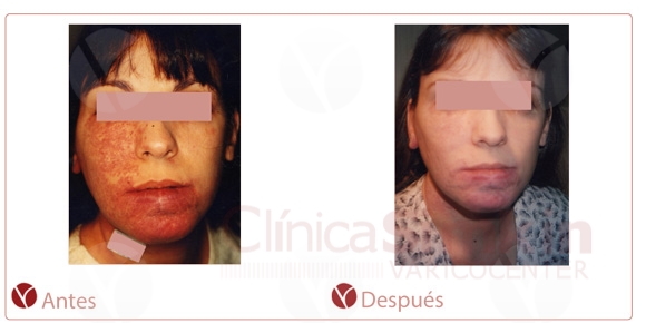 antes-y-despues-angiomas-cuello2