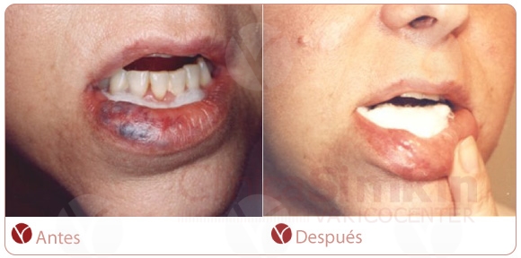 Angioma de labios. Post-tratamiento Angioma de labios. Post-tratamiento