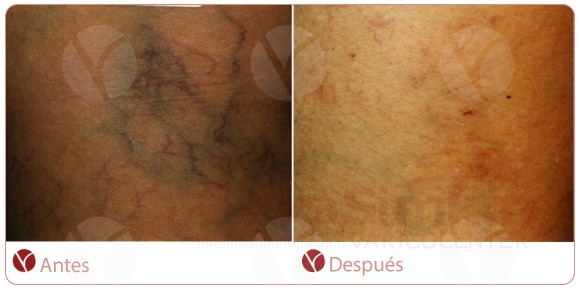 Flebología: tratamientos con cryo-láser. Flebología: tratamientos con cryo-láser.