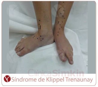Síndrome de Klippel Trenaunay. Hipertrofia. Síndrome de Klippel Trenaunay. Hipertrofia.
