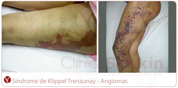 Síndrome de Klippel Trenaunay. Angiomas. Síndrome de Klippel Trenaunay. Angiomas.