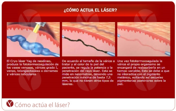 Láser para arañitas. Sin dolor. Láser para arañitas. Sin dolor.