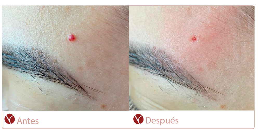 Angioma Rubí - Antes y Después