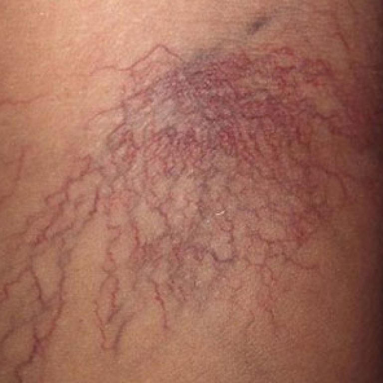 antes-varices1